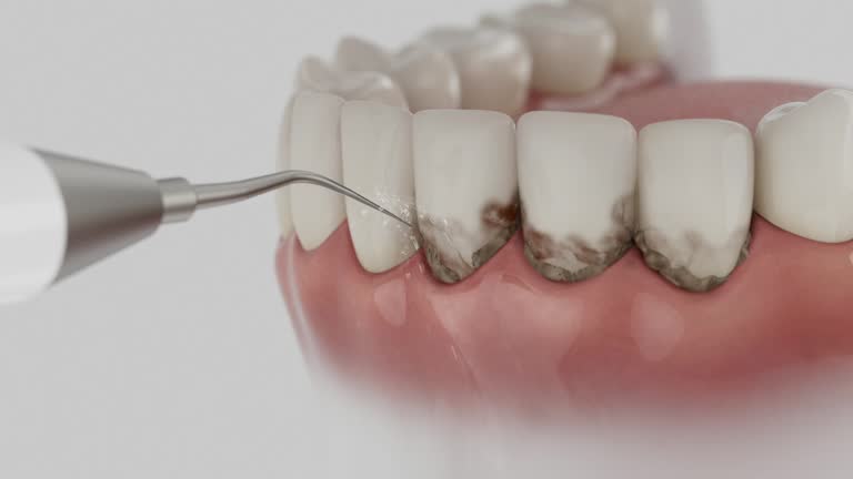 Reliable Teeth Whitening contractor in Long Beach, CA by Smile Center Dentistry